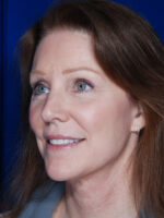 Facelift
