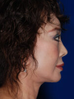 Facelift