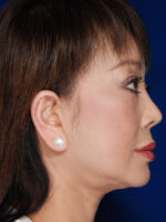 Facelift