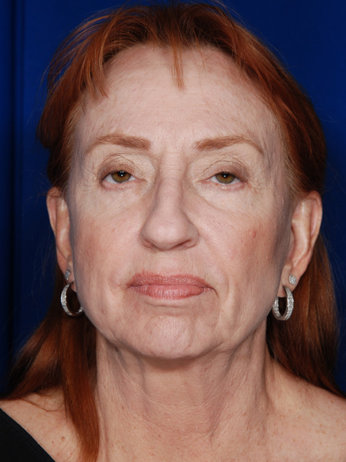 Facelift