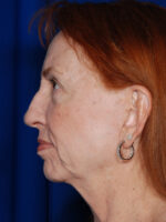 Facelift