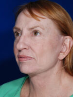 Facelift