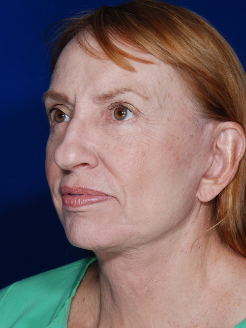 Facelift