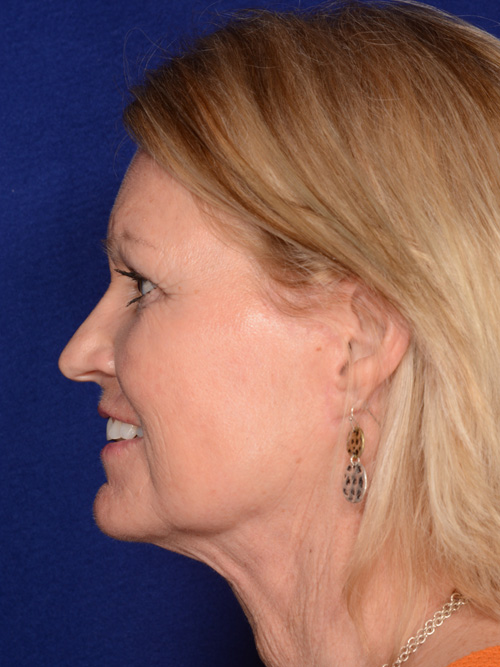 The Aging Face