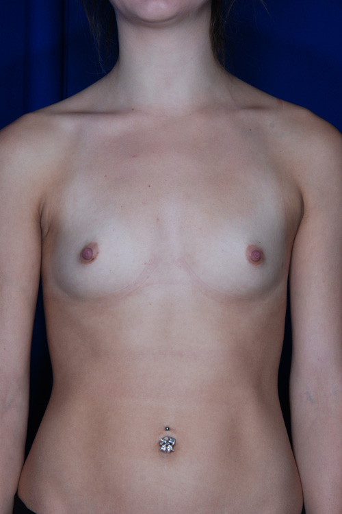 Breast Augmentation