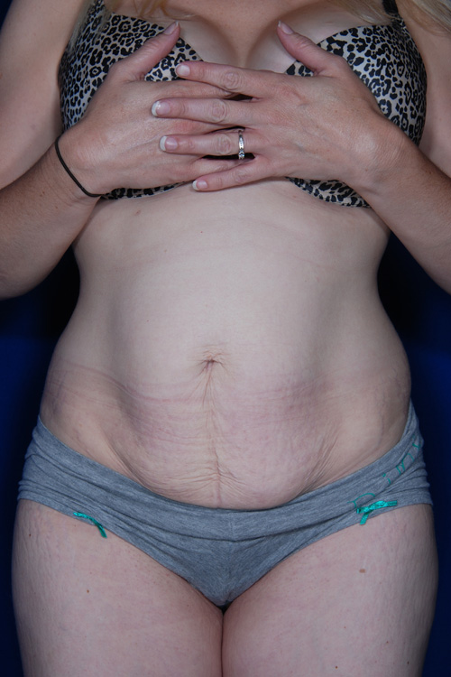 Abdominoplasty