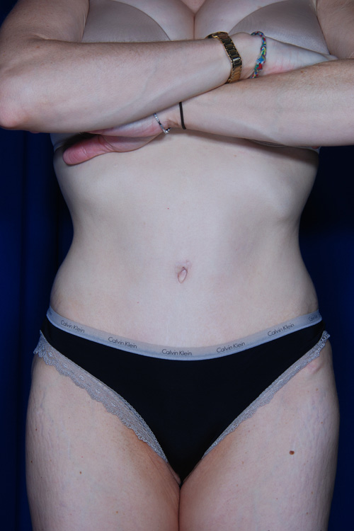 Abdominoplasty
