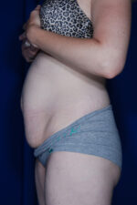 Abdominoplasty
