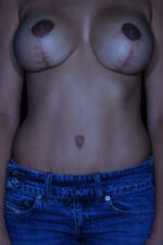 Abdominoplasty