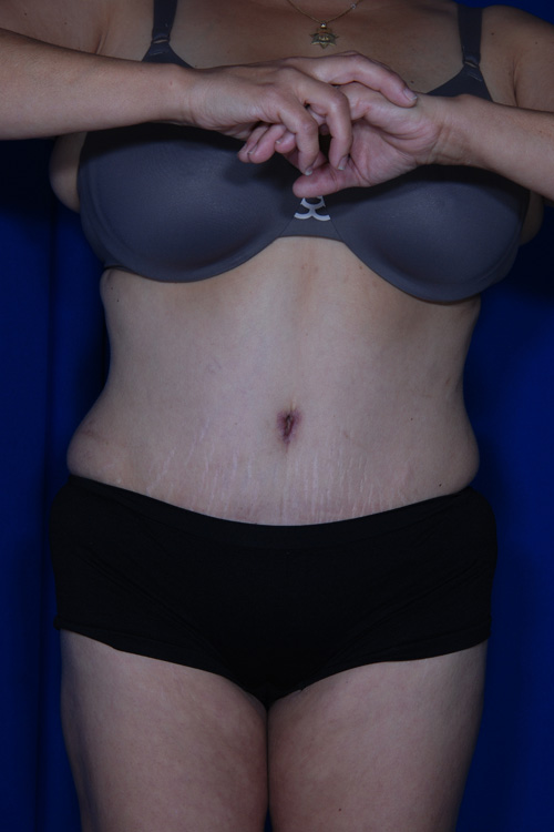 Abdominoplasty