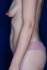 Abdominoplasty