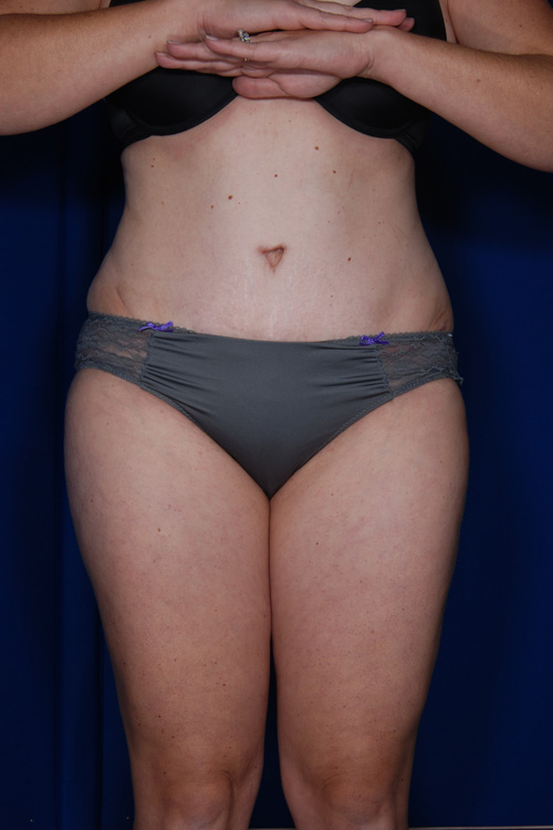 Abdominoplasty