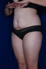 Abdominoplasty