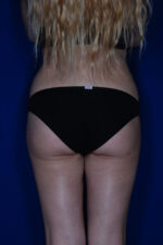 Brazilian & Fat Transfer Butt Lift