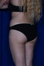 Brazilian & Fat Transfer Butt Lift