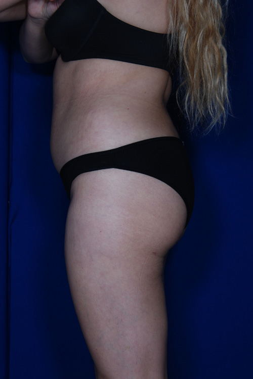 Brazilian & Fat Transfer Butt Lift