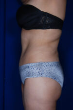 Abdominoplasty