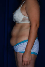 Abdominoplasty