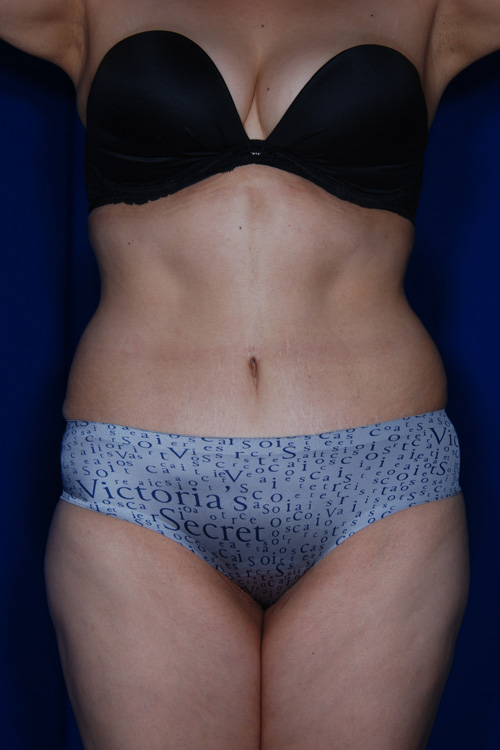 Abdominoplasty