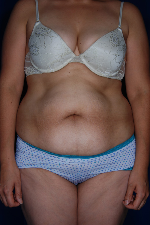 Abdominoplasty