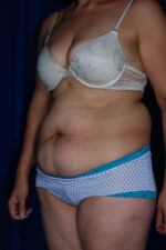 Abdominoplasty