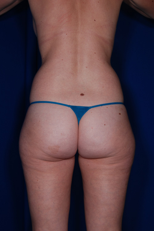 Brazilian & Fat Transfer Butt Lift