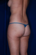 Brazilian & Fat Transfer Butt Lift