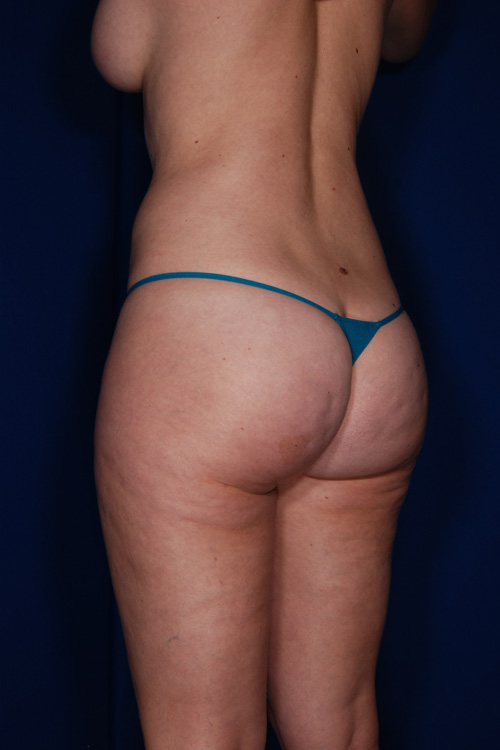 Brazilian & Fat Transfer Butt Lift