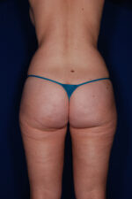 Brazilian & Fat Transfer Butt Lift