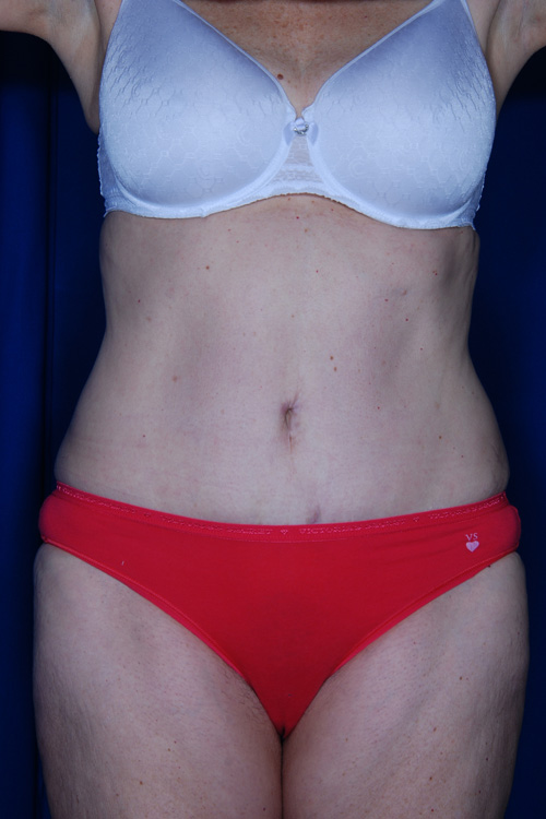 Abdominoplasty