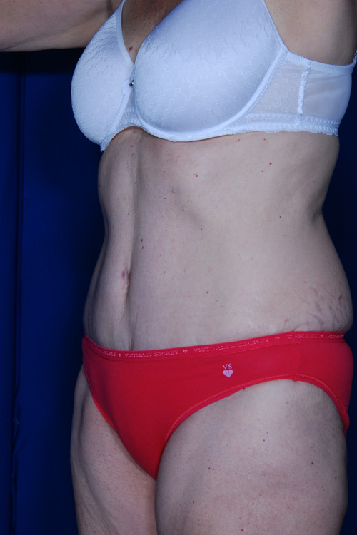 Abdominoplasty