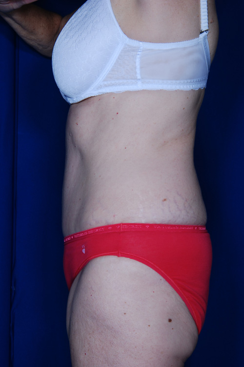 Abdominoplasty