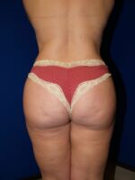 Brazilian & Fat Transfer Butt Lift