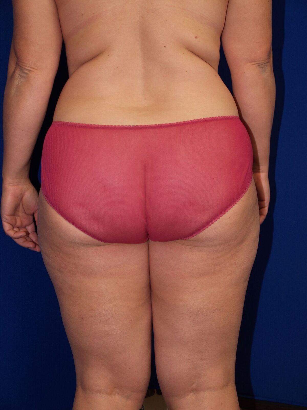 Brazilian & Fat Transfer Butt Lift