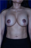 Revisional Breast Augmentation