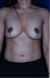 Revisional Breast Augmentation