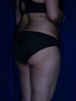 Liposuction