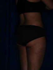 Liposuction