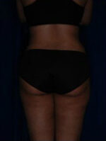 Liposuction