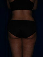 Liposuction