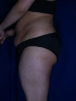 Liposuction