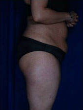 Liposuction