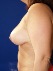 Breast Lift