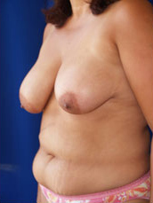 Breast Lift