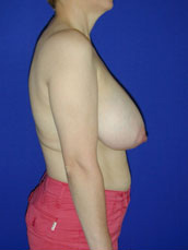 Breast Lift