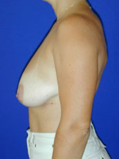 Breast Lift
