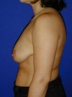 Breast Lift