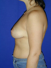 Breast Lift
