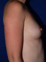 Breast Augmentation