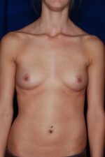 Breast Augmentation